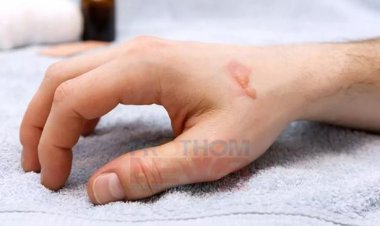 পুড়ে গেলে কী করবেন