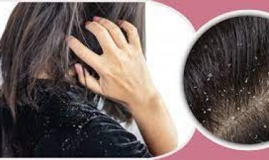 খুশকি দূর হবে এক উপাদানেই