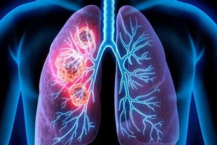 ফুসফুসে ক্যান্সার হতে পারে ৬ কারণে