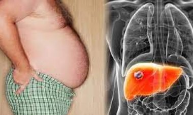 ফ্যাটি লিভার কেন হয়? আক্রান্ত হলে দ্রুত যা করবেন