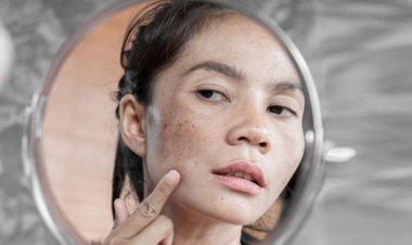 মেছতা থেকে মুক্তি পেতে যা করবেন