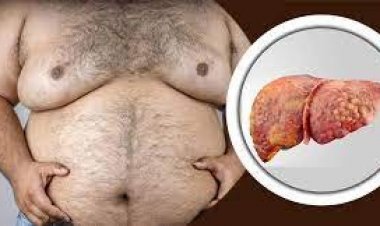 ফ্যাটি লিভারের রোগীরা কী খাবেন ও কী খাবেন না?