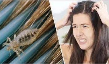 রাতারাতি মাথার উকুন দূর করার ৫ উপায়