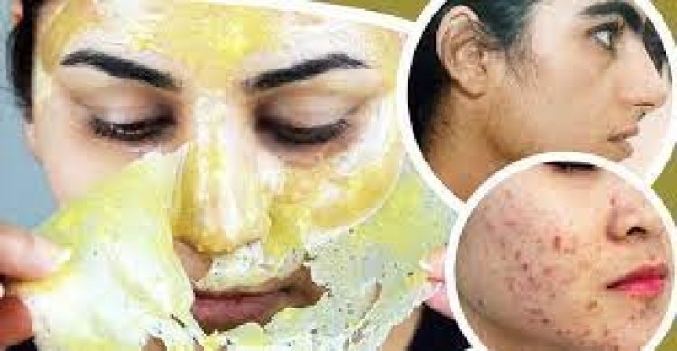 মুখের কালো দাগ ও লোম তুলতে যেভাবে মাখবেন ডাল