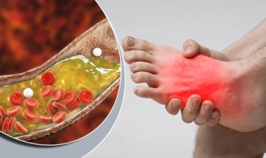 কোলেস্টেরল বেড়েছে কি না বুঝে নিন পা দেখেই