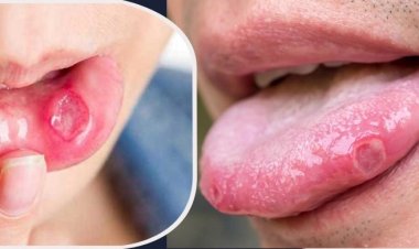 মুখের ঘা সারানোর ঘরোয়া ৫ উপায়