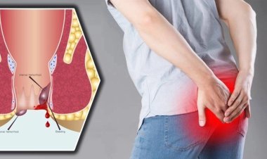 পাইলসের সমস্যা সমাধানের ঘরোয়া ৫ উপায়