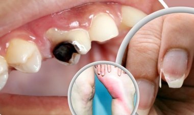 শরীরে ক্যালসিয়ামের ঘাটতি জানান দেয় যেসব লক্ষণ