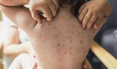 অ্যান্টিভাইরাল ওষুধই হতে পারে মাঙ্কি পক্সের বিরুদ্ধে লড়ার হাতিয়ার