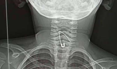 নুডলস খেতে গিয়ে শিশুর গলায় আটকে গেল সেফটি পিন