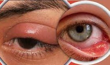 চোখে ‘অঞ্জনি’ হলে দ্রুত সারাতে যা করবেন