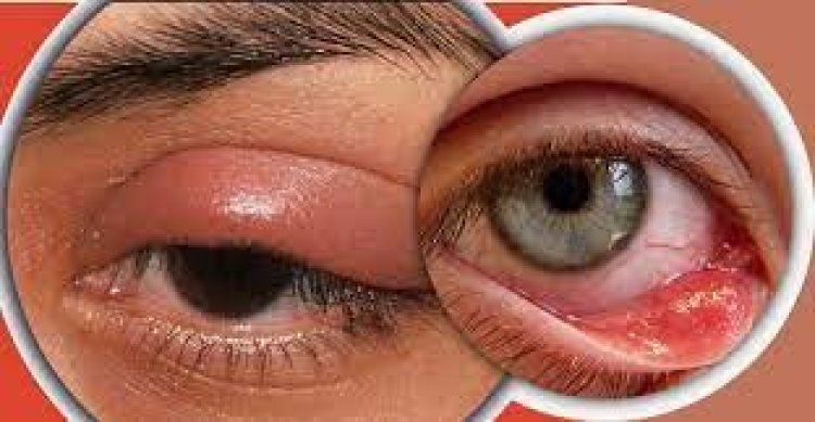 চোখে ‘অঞ্জনি’ হলে দ্রুত সারাতে যা করবেন