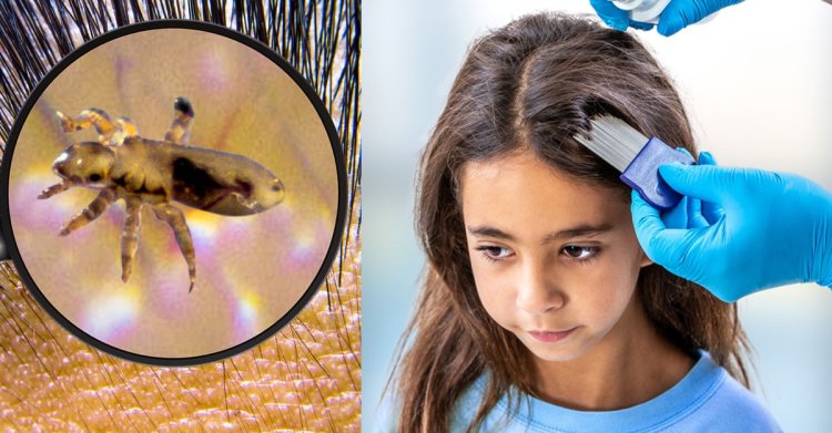 উকুন দূর করার ঘরোয়া উপায়