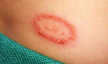 দাদের চুলকানি ও ক্ষত সারানোর ৫ ঘরোয়া উপায়