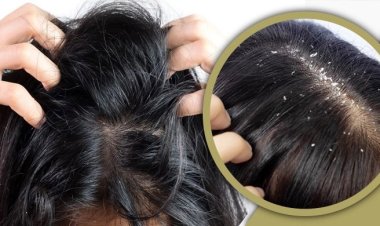 শীতে খুশকির সমস্যা সমাধান করুন ১০ উপায়ে