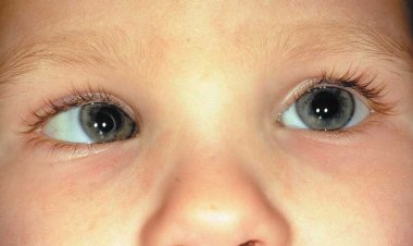 বছরে ঢাকা শহরে প্রায় ২ লাখ ৭০ হাজার শিশু চোখের রোগে আক্রান্ত হচ্ছে