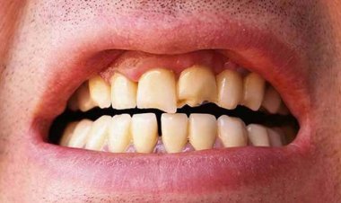 দাঁতের ক্ষয় যেভাবে প্রতিরোধ করবেন