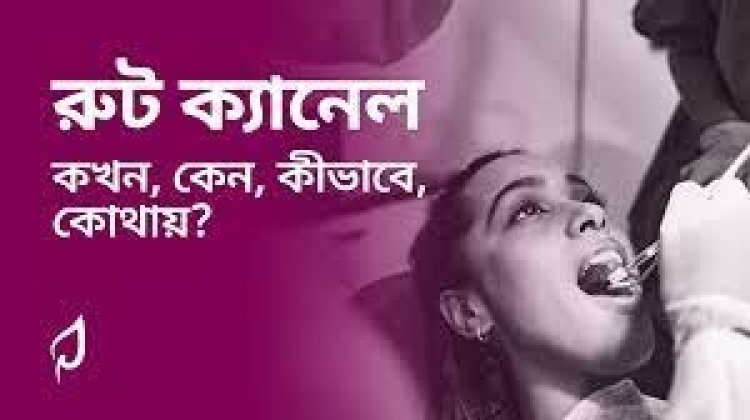দাঁতে গর্ত হলে রুট ক্যানেল না ফিলিং?