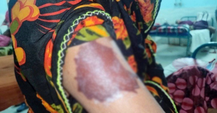 যৌতুক না পেয়ে গৃহবধূকে বৈদ্যুতিক ইস্ত্রি দিয়ে ছ্যাঁকা