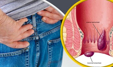 পাইলস কেন হয়, এর লক্ষণ কী কী?