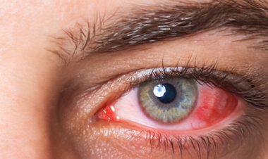 ক্যানসারের যে লক্ষণ ফুটে ওঠে চোখে