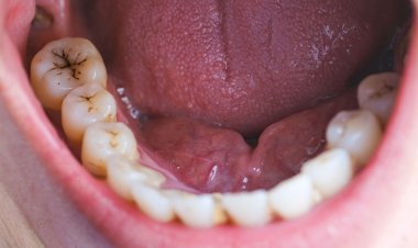 দাঁতে পাথর জমলে যা করবেন