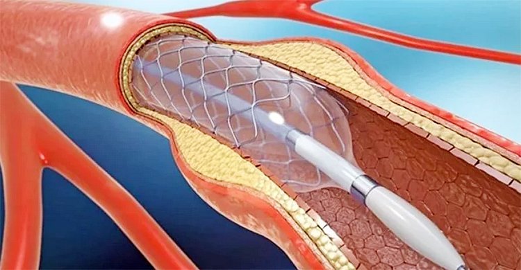 আলোচনার পরও হার্টের রিং বিক্রি বন্ধ, বিপাকে রোগীরা