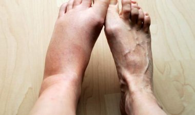  শীতে হাত-পা ফুলে যায় কেন?