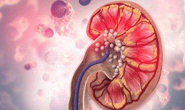 যেসব খাবার অতিরিক্ত খেলে কিডনিতে পাথর হয়