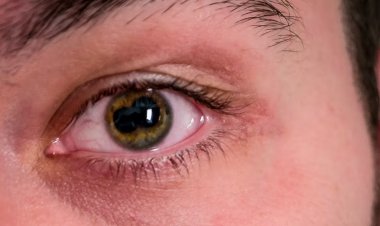 আর্থ্রাইটিস কি চোখেও হতে পারে?